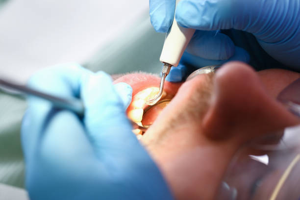Best Emergency Wisdom Teeth Removal in Aledo, TX