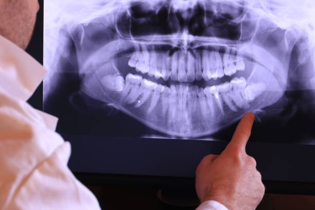 Best Emergency Wisdom Teeth Removal in Aledo, TX
